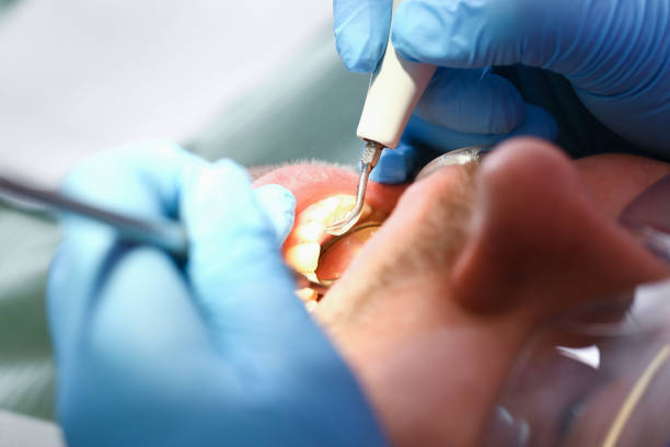 Best Emergency Dental Care for Abscessed Tooth in London, OH
