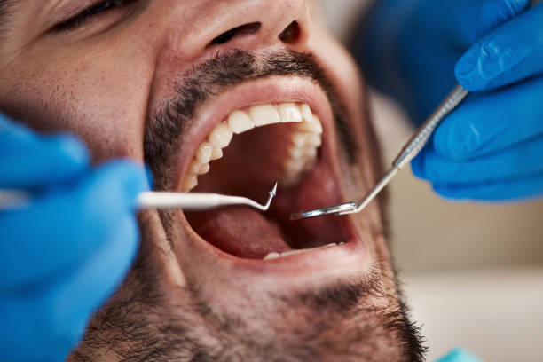 Best Emergency Dentist for Lost Fillings or Crowns in London, OH